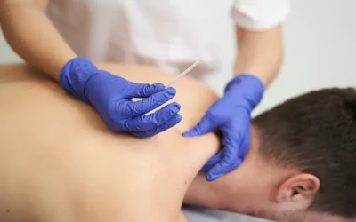 Effective Dry Needling Treatment for Sciatica Pain Relief