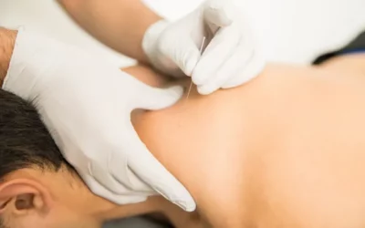 Does Dry Needling Hurt? What You Need to Know Before Your Visit
