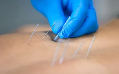 Dry Needling Treatment in Dallas for Cervicogenic Headaches